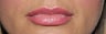 30 year old female desires Juvederm in lips