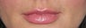 30 year old female desires Juvederm in lips
