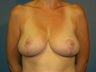 Breast reduction in a 34 DDD