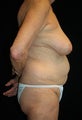 Body Lift