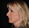 Rhinoplasty