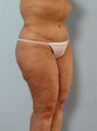 Body Lift