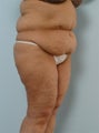 Body Lift