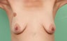 Breast Lift and Augmentation