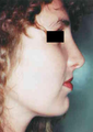 Revision Rhinoplasty