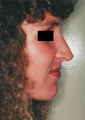 Revision Rhinoplasty