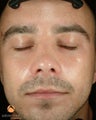 Male treated with 5 Photodynamic Therapy with Levulan for acne