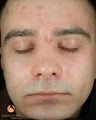 Male treated with 5 Photodynamic Therapy with Levulan for acne