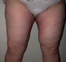 Female patient who underwent a thigh lift