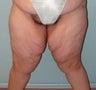 Female patient who underwent a thigh lift