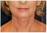 Facelift