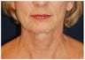 Facelift