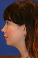 Chin/Neck Liposuction