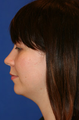 Chin/Neck Liposuction