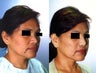 Asian American Rhinoplasty