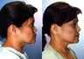 Asian American Rhinoplasty