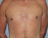 Male Breast Reduction/Gynecomastia