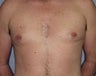Male Breast Reduction/Gynecomastia