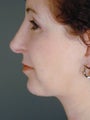 Female Chin Implant