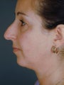 Female Chin Implant