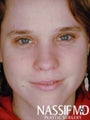 Female Revision Rhinoplasty