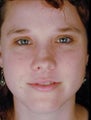 Female Revision Rhinoplasty