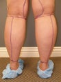 Tumescent Liposuction Under Local Anesthesia.