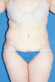 Circumferential Tuck