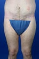 36 Year Old Male Weight Loss Patient Treated With A Body Lift