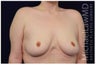 Breast Lift - Mastopexy