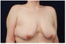 Breast Lift - Mastopexy