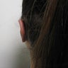 Ear Pinning (Otoplasty)
