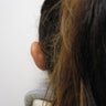 Ear Pinning (Otoplasty)