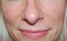 Laser treatment for facial veins and redness