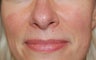 Laser treatment for facial veins and redness