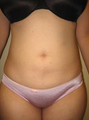 Liposuction