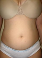 Liposuction