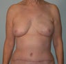 61-year-old female with left nipple-sparing immediate DIEP breast reconstruction through inframammary incision
