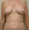 61-year-old female with left nipple-sparing immediate DIEP breast reconstruction through inframammary incision