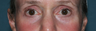 Fraxel Laser Before & After
