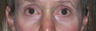 Fraxel Laser Before & After