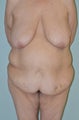 Lower body lift and breast augmentation