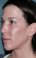 Fraxel Repair for Face