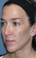 Fraxel Repair for Face