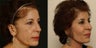 Fat transfer with blepharoplasty
