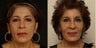 Fat transfer with blepharoplasty