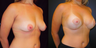Breast Lift with Implants, Mastopexy