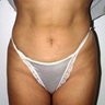 Liposuction
