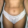 Liposuction