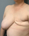 Breast Reconstruction
